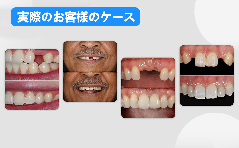 1本 カスタム 入れ歯 部分 取り外し可能 Dentellea 義歯 携帯